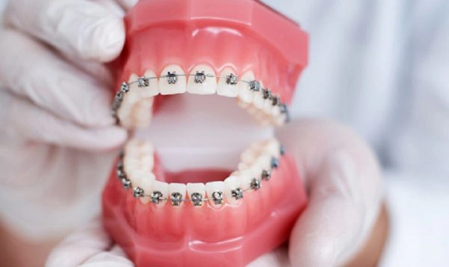 Niềng Răng Có Làm Thay Đổi Khuôn Mặt Không? Những Điều Bạn Chưa Biết