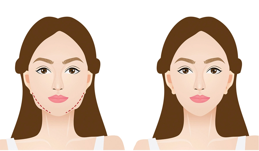 Niềng Răng Có Làm Thay Đổi Khuôn Mặt Không? Những Điều Bạn Chưa Biết