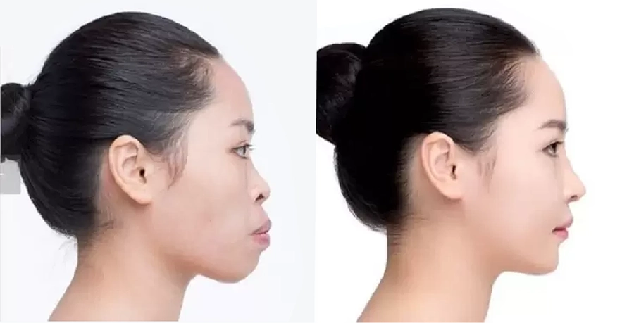 Niềng Răng Có Làm Thay Đổi Khuôn Mặt Không? Những Điều Bạn Chưa Biết