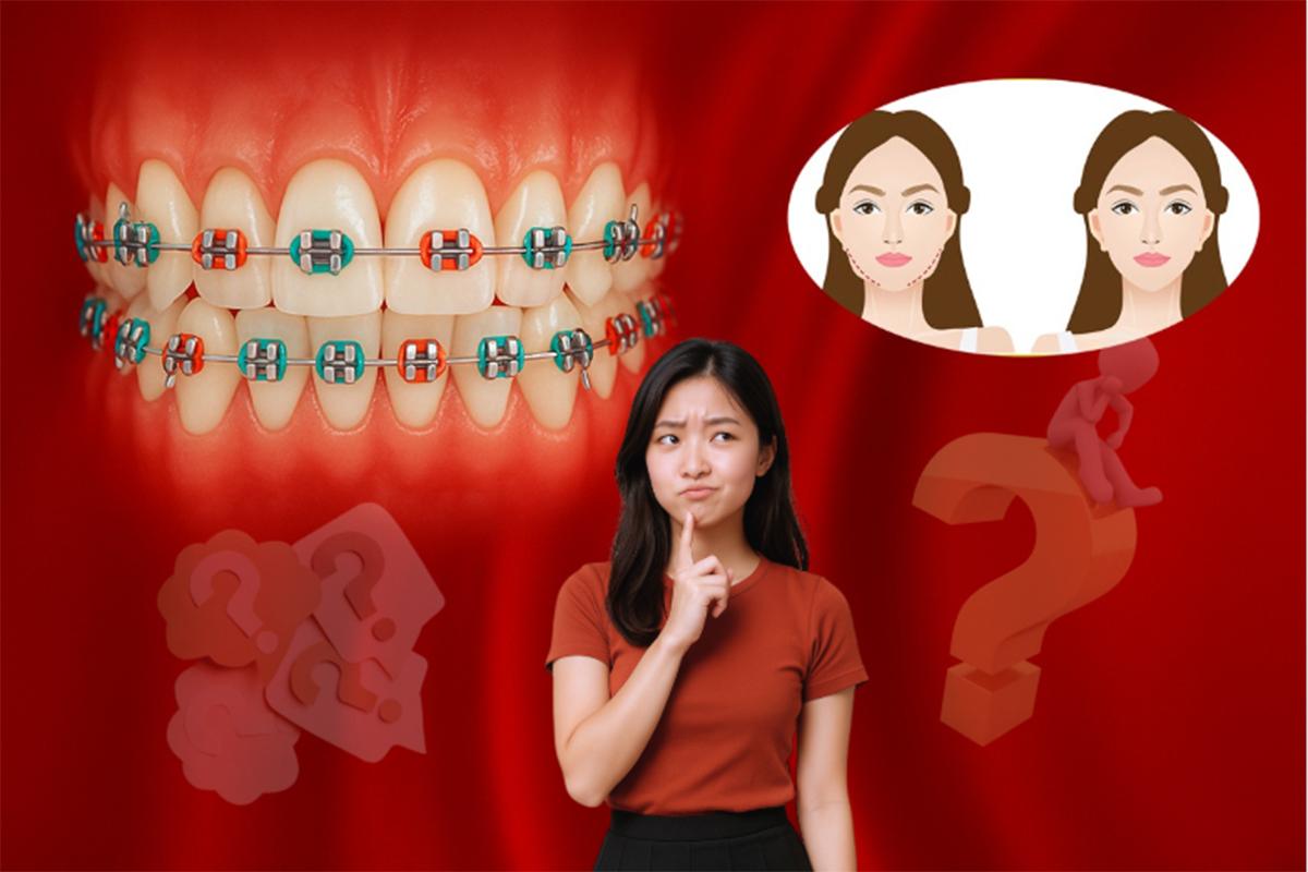 Niềng Răng Có Làm Thay Đổi Khuôn Mặt Không? Những Điều Bạn Chưa Biết