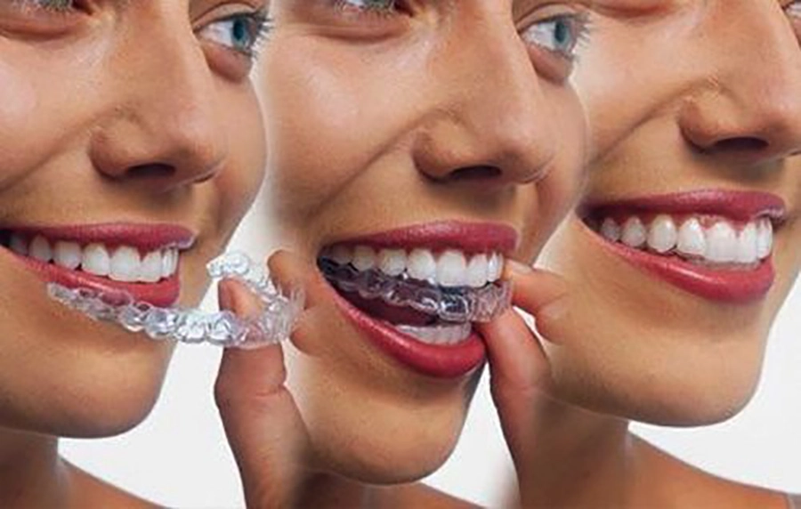 Niềng Răng Trong Suốt Là Gì? Giải Pháp Thẩm Mỹ Cho Người Ngại Đeo Mắc Cài