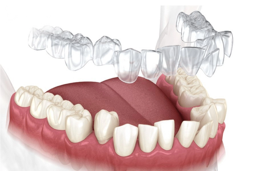 Niềng Răng Trong Suốt Là Gì? Giải Pháp Thẩm Mỹ Cho Người Ngại Đeo Mắc Cài