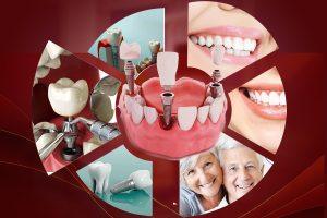 Quy Trình Cấy Ghép Implant Tiêu Chuẩn Tại Nha Khoa Sài Gòn 3M – Hành Trình Phục Hồi Nụ Cười