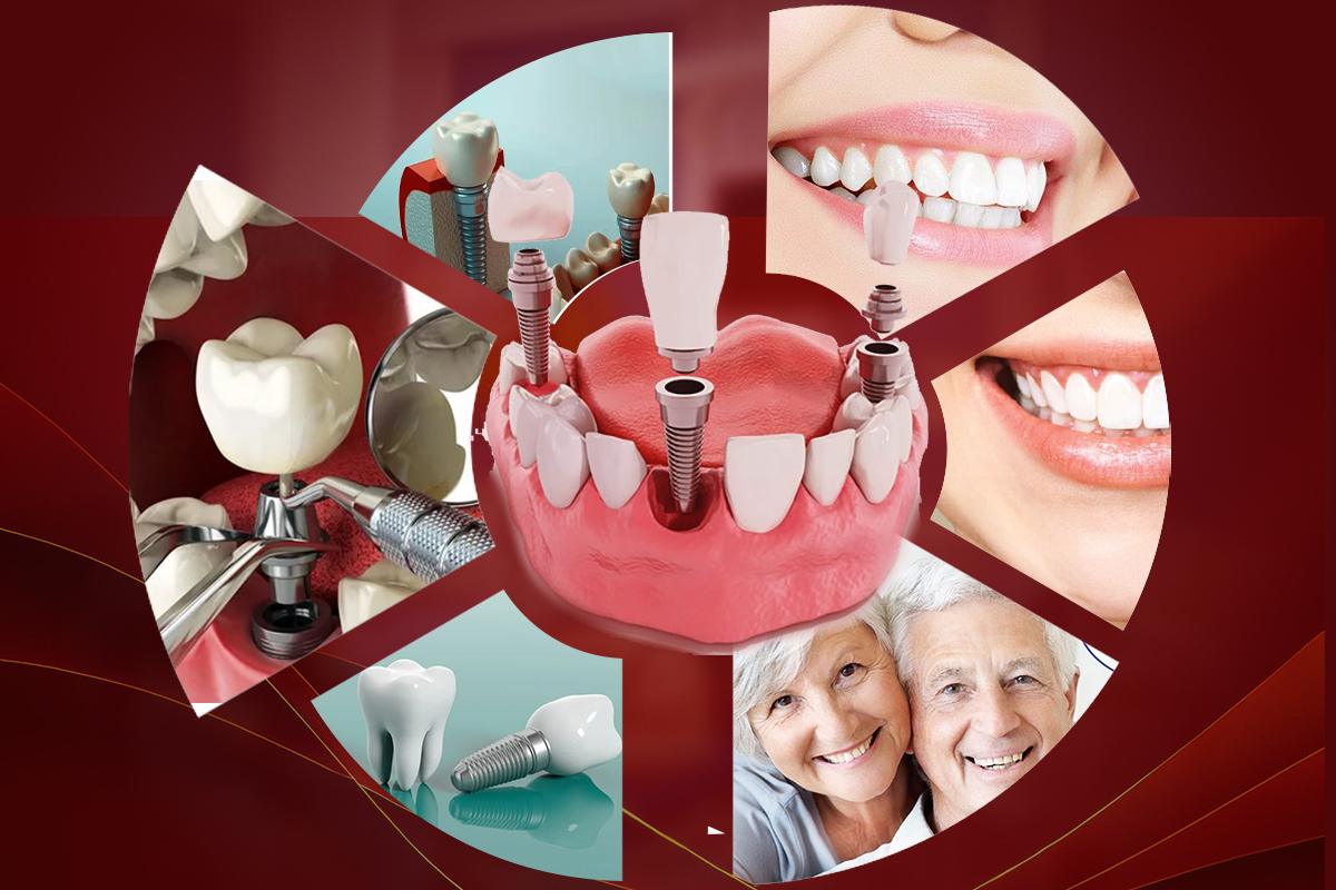 Quy Trình Cấy Ghép Implant Tiêu Chuẩn Tại Nha Khoa Sài Gòn 3M – Hành Trình Phục Hồi Nụ Cười