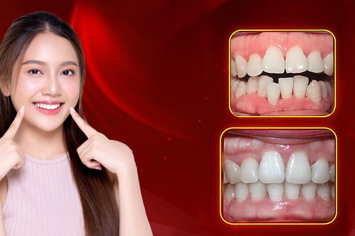 Quy Trình Niềng Răng Tại Nha Khoa Sài Gòn 3M: Bí Quyết Tự Tin Với Nụ Cười Hoàn Hảo