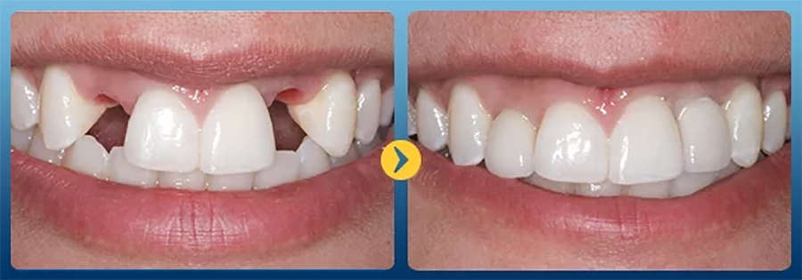 Trồng răng Implant: Lợi ích vượt trội so với phương pháp truyền thống