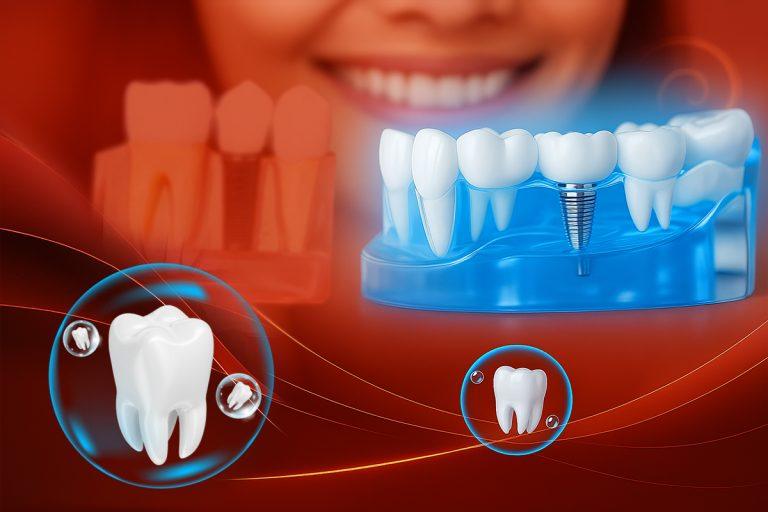 Trồng răng Implant: Lợi ích vượt trội so với phương pháp truyền thống