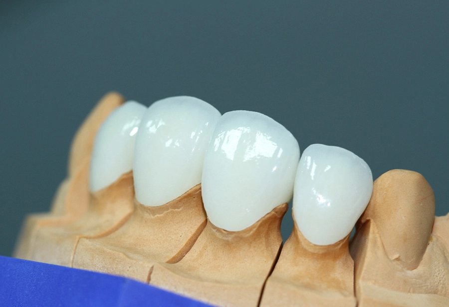 5 lý do răng sứ toàn sứ được ưa chuộng