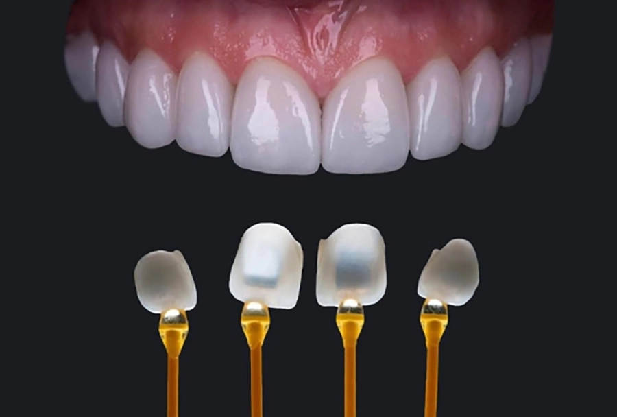 5 lý do răng sứ toàn sứ được ưa chuộng