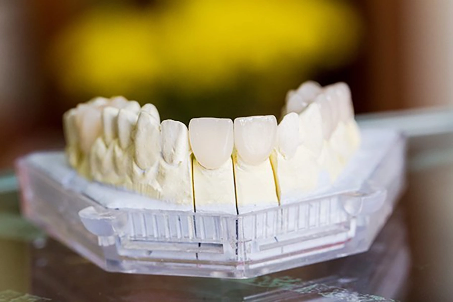 5 lý do răng sứ toàn sứ được ưa chuộng