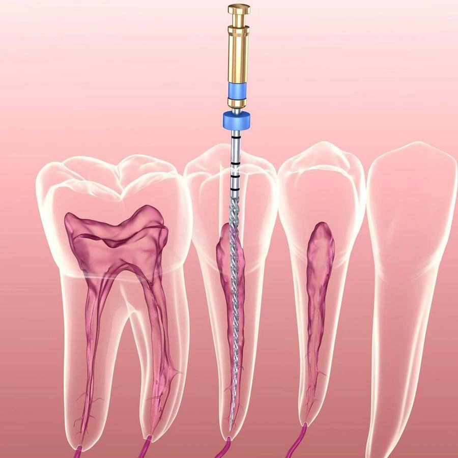 Điều Trị Tủy Có Đau Không?