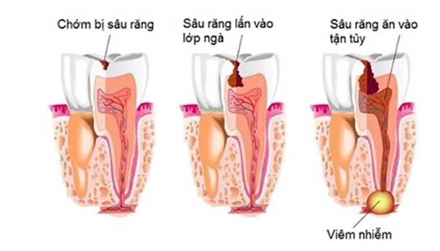 Điều Trị Tủy Có Đau Không?