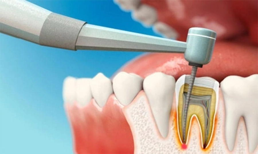 Điều Trị Tủy Có Đau Không?