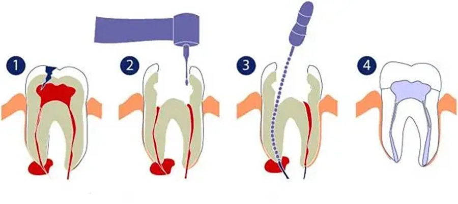 Điều Trị Tủy Có Đau Không?
