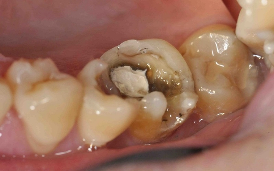 Điều Trị Tủy Có Đau Không?