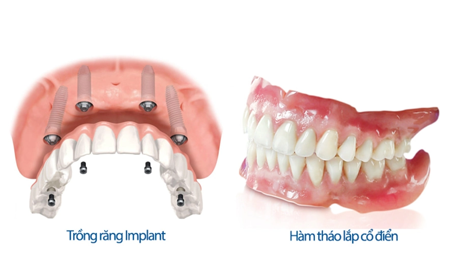 Hàm tháo lắp vs Implant: Giải pháp nào cho người mất răng tuổi già?