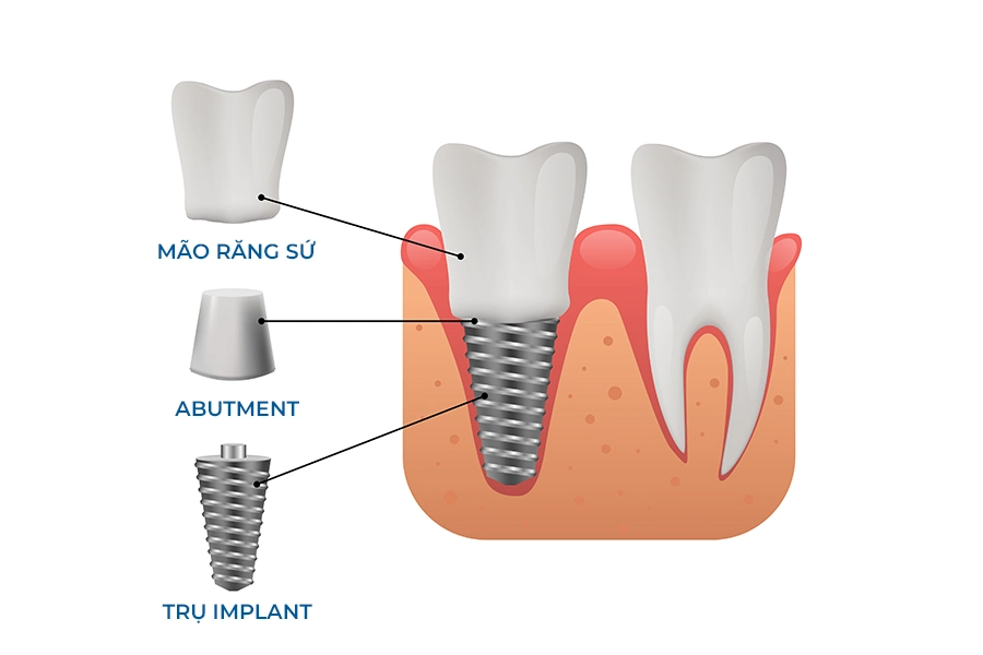 Hàm tháo lắp vs Implant: Giải pháp nào cho người mất răng tuổi già?