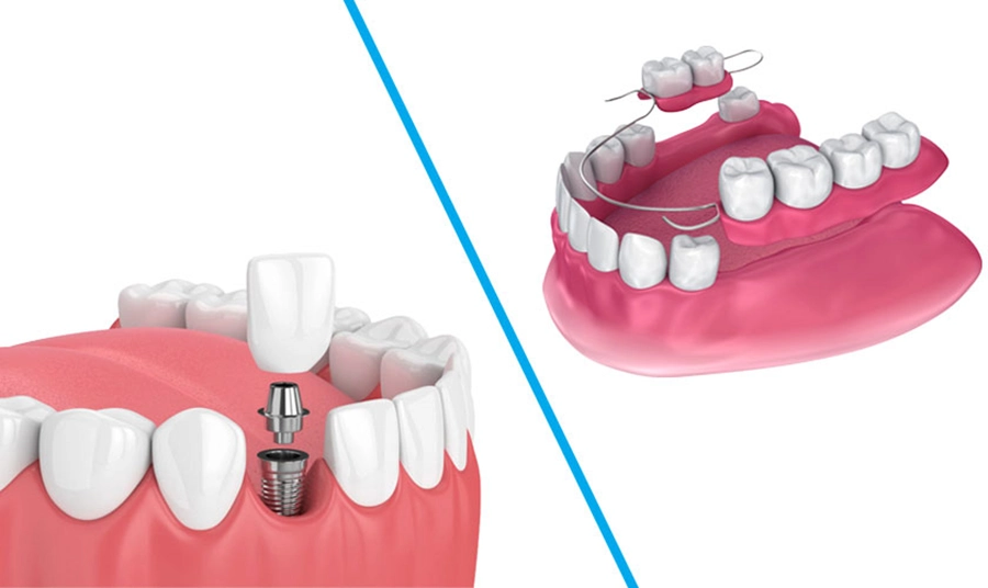 Hàm tháo lắp vs Implant: Giải pháp nào cho người mất răng tuổi già?