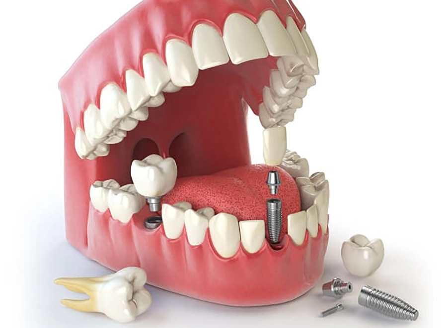 Hàm tháo lắp vs Implant: Giải pháp nào cho người mất răng tuổi già?
