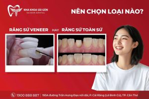 Răng Sứ Veneer Hay Răng Sứ Toàn Sứ – Nên Chọn Loại Nào?