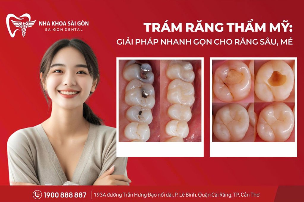 Trám răng thẩm mỹ: Giải pháp nhanh gọn cho răng sâu, mẻ
