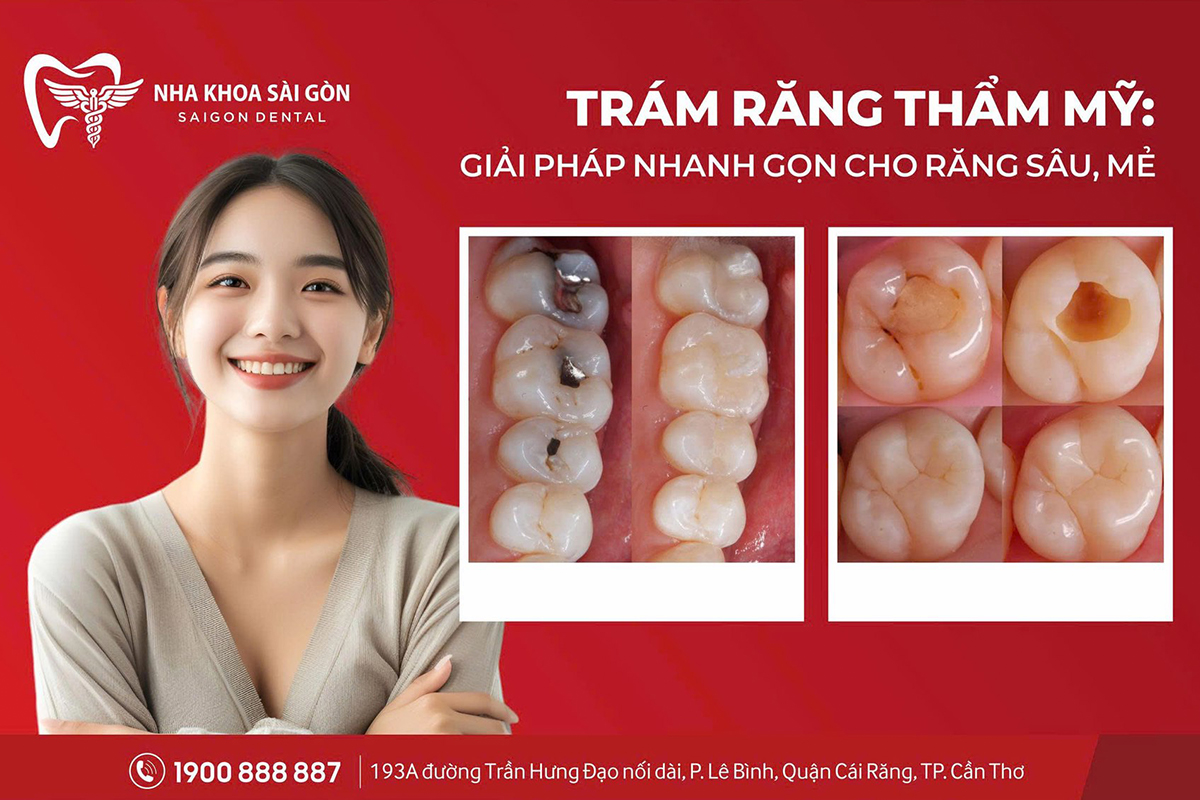 Trám răng thẩm mỹ: Giải pháp nhanh gọn cho răng sâu, mẻ