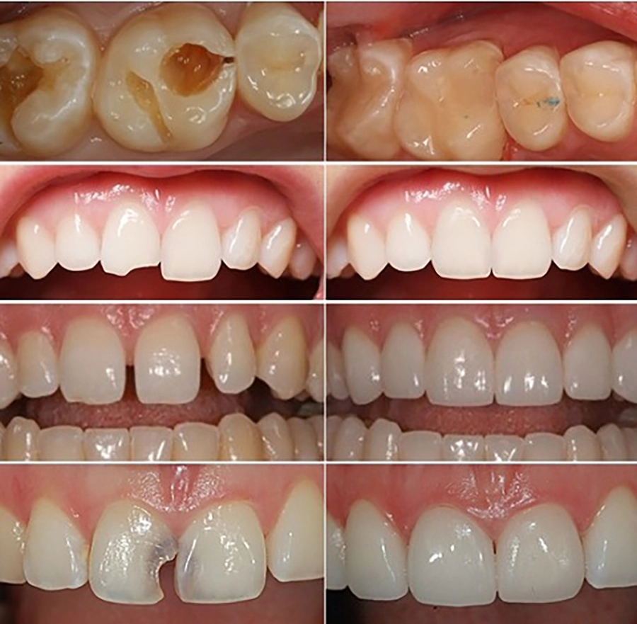 Trám răng thẩm mỹ: Giải pháp nhanh gọn cho răng sâu, mẻ
