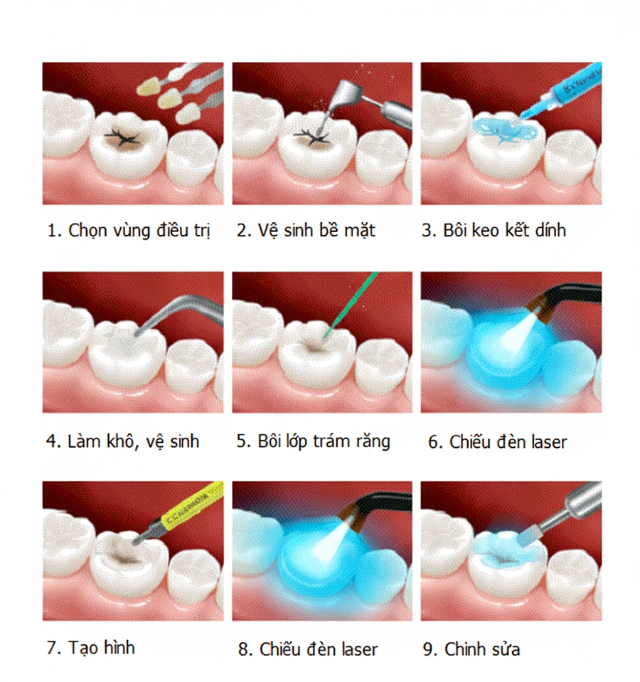 Trám răng thẩm mỹ: Giải pháp nhanh gọn cho răng sâu, mẻ